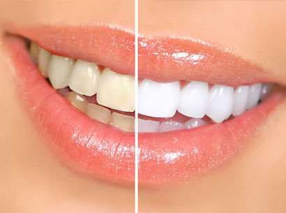 Before and after This is it Dental Smile Makeover Harley Street Dentist